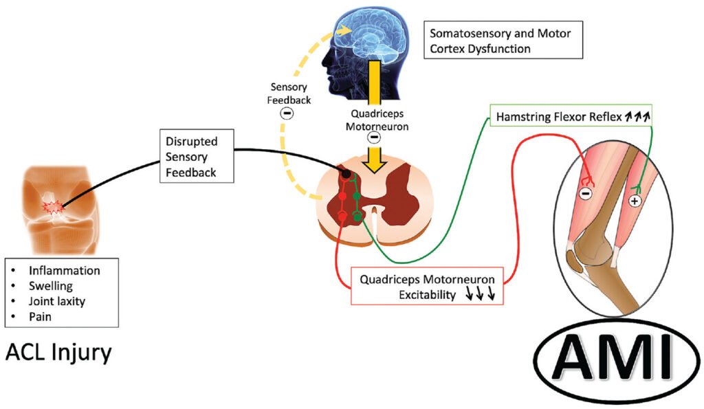 Arthrogenic Muscle Inhibition (AMI) and Disinhibition